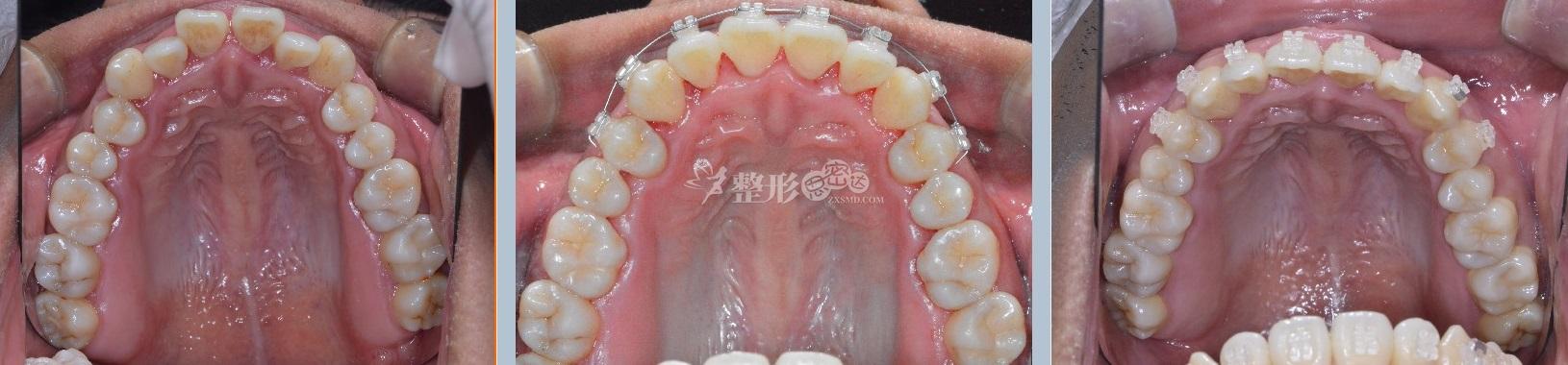 在韩国优露牙科,利用陶瓷矫治器 接受了7个月的上牙局部快速矫正